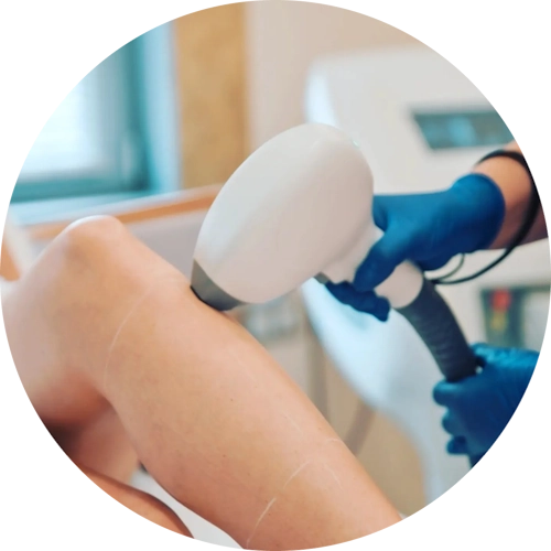 Лазерна епилация